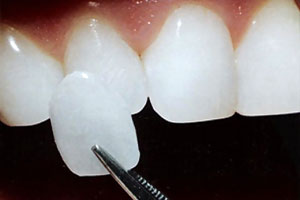 Cosmetic Dentistry - Santa Maria