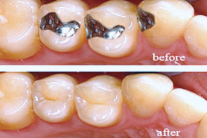 Dental Restoration - Santa Maria