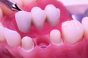 Dental Restoration - Santa Maria